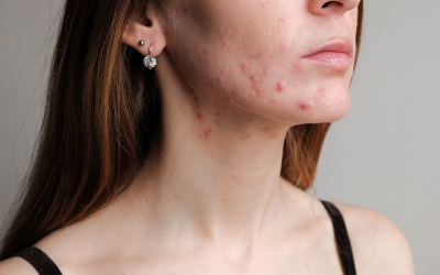 How Food Sensitivity Testing Can Fix Your Acne