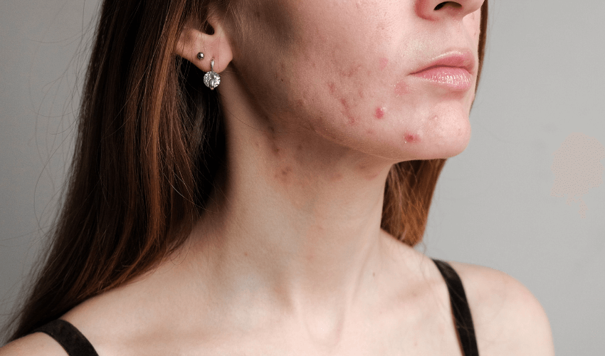 How Food Sensitivity Testing Can Fix Your Acne